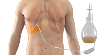 FIGURE. Pleural catheter and vacuum bottle. Courtesy and © Becton, Dickinson and Company. Reprinted with permission