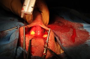 Erectile Dysfunction Surgery