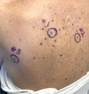 FIGURE 2. Sites of punch biopsies