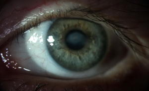FIGURE 1. Anterior segment photograph of the patient with neurotrophic keratopathy demonstrating a central corneal scar