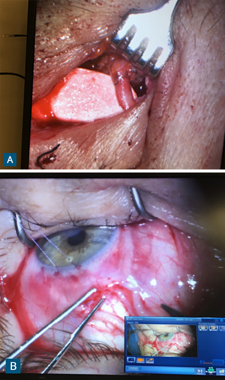 FIGURE 2. (A) Intraoperative photograph showing anastomosis between the nerve graft and deceased-donor supratrochlear nerve performed through a small eyelid incision; (B) Fascicles of the nerve graft are inset in the subconjunctival space around the corneoscleral limbus