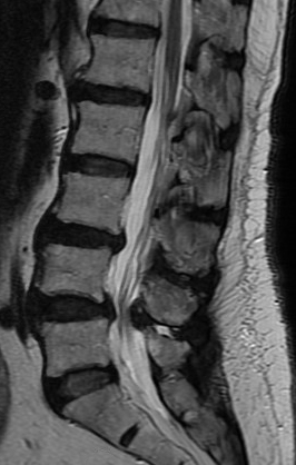 FIGURE 1. Radiography shows mild compression fracture and spondylolisthesis.