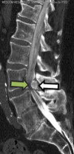 Figure 1. CT Myelogram Sagittal Image. Large calcified mass at L3-4 (white arrow) with critical spinal stenosis and myelographic block (green arrow); evidence of prior fusion L4-S1