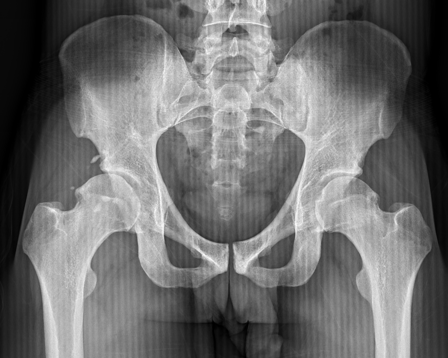 Damaged Hip Cartilage Replaced with First-of-its-Kind Procedure | Duke ...