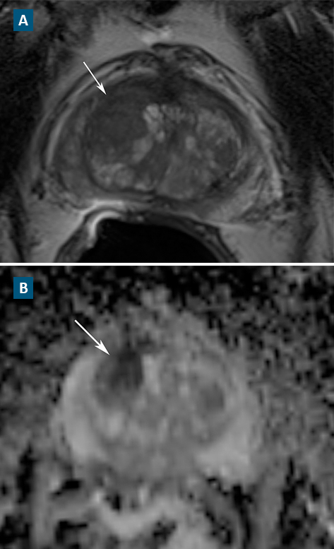 FIGURE. (A) T2-weighted magnetic resonance imaging and (B) apparent diffusion coefficient map