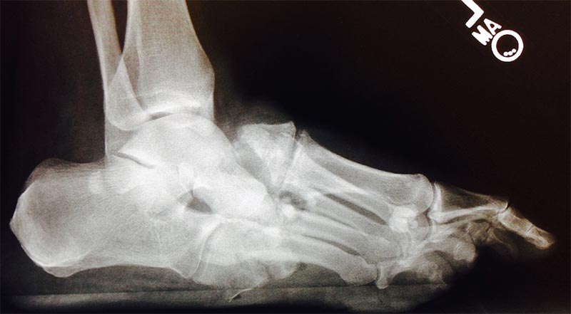 FIGURE 1. Progressive fragmentation and collapse 2 months after initial presentation