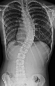 FIGURE. Scoliosis presentation similar to that of the patient in this case.