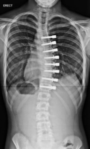 FIGURE. Vertebral tethering procedure in a patient with scoliosis. A polypropylene rope is used to promote a convex curve.