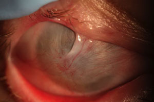 FIGURE 1. Right eye prior to transplant