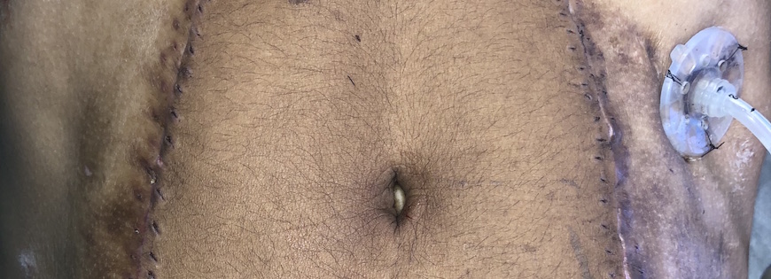 Abdomen with stitches