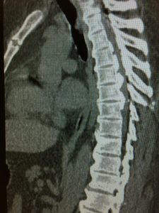 Intraoperative-Visualization-Improves-Outcomes-for-Complex-Spine-Surgery