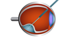 subretinal injection