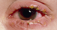 Blepharitis