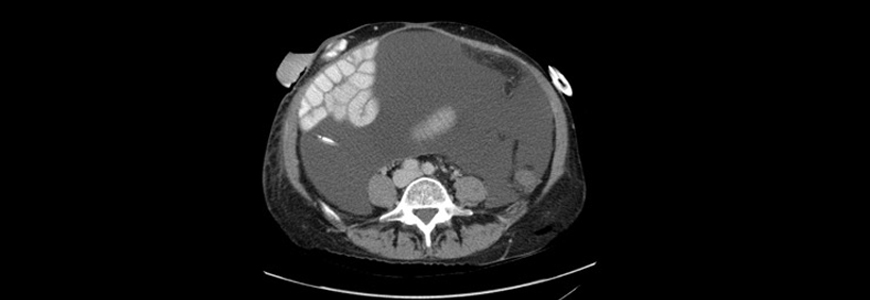 CT image showing large volume ascites and Leveen catheter tip