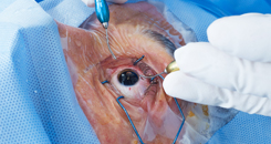 Cataract surgery