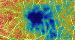 Loss of Blood Vessels in Retina May Signal Alzheimer’s Disease