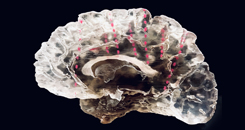 Imaging Innovation: 3-D Surgical Planning for Intractable Epilepsy