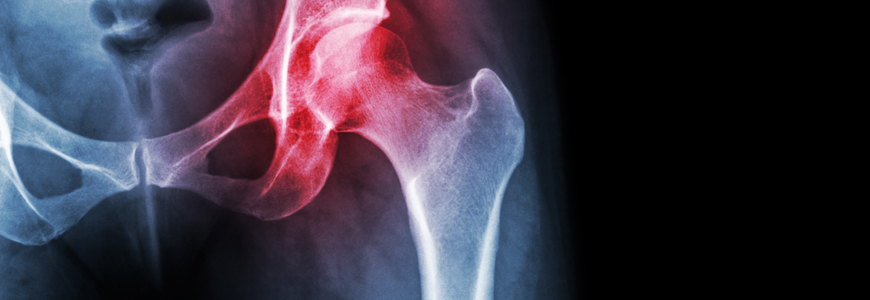 Inflamed hip joint