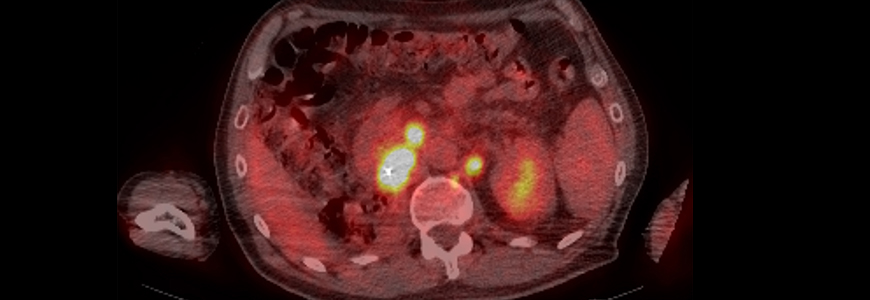Kidney showing metastatic cancer