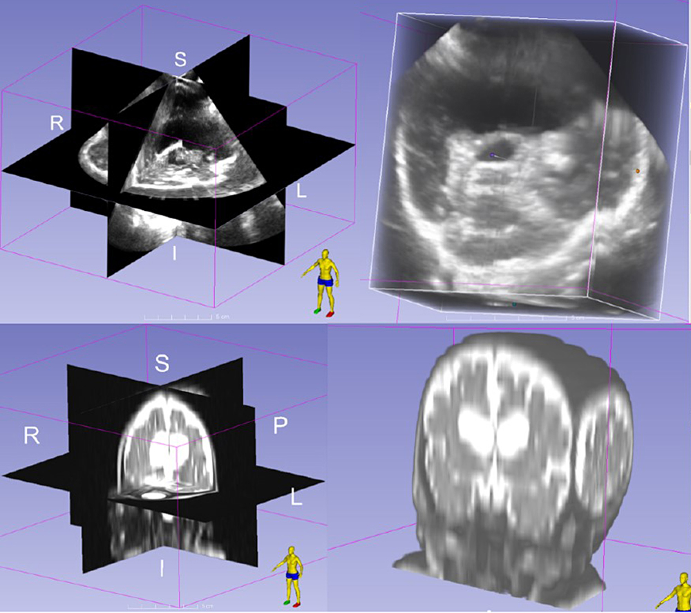 FIGURE: Top, 3-D ultrasound images in an infant with hydrocephalus; bottom, MRI scans from the same patient.