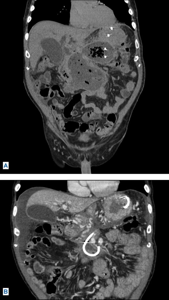 FIGURE 2: (A) CT of patient after several interventions. (B) CT of patient after interventions were completed, showing full resolution of walled-off necrosis.