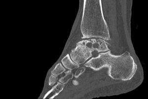 FIGURE 1: Preoperative CT scan of the patient’s ankle showing degenerative changes in the ankle and large cysts abutting the subtalar joint.