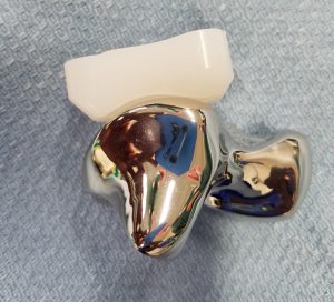 FIGURE 2: 3-D–printed talus ready for implantation. The top of the talar dome marries perfectly with the polyethylene of a total ankle replacement.