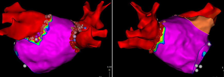 Two views of the segmented left atrium, created with an electro-anatomic mapping system during a therapeutic catheter ablation procedure to treat atrial fibrillation