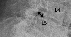 L4 vertebral body is shifted about 9 mm in front of  L5
