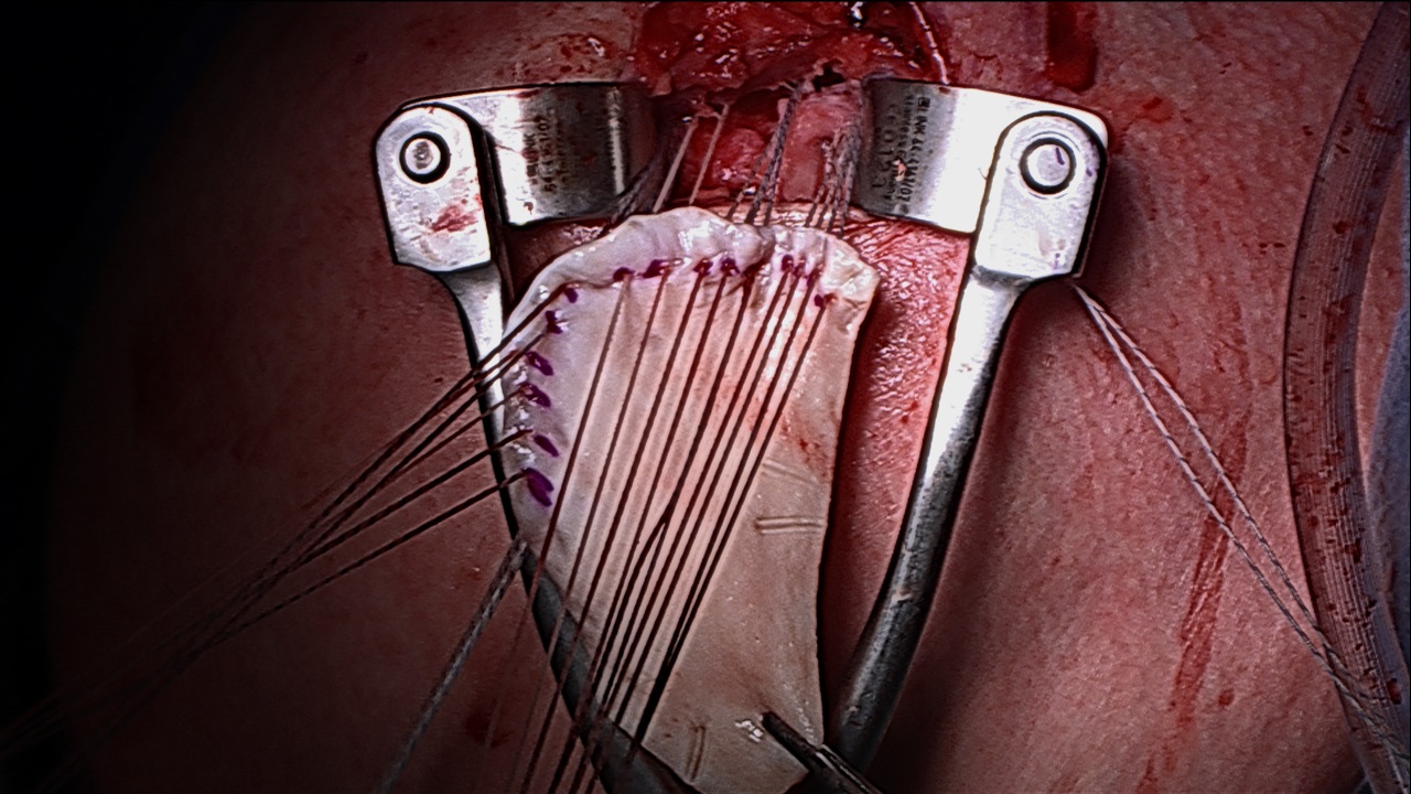 Success With Grafting Technique After Severe Rotator Cuff Injury