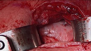 FIGURE 2: Rotator cuff graft post-implantation. Image courtesy of Alison Toth, MD.