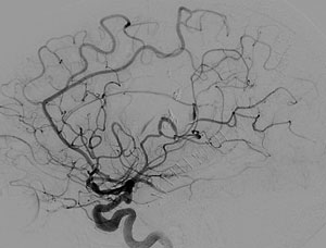 FIGURE 2. X-ray of patient’s head following surgery showing absence of AVM