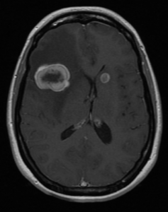 FIGURE 1. Before frontal crani 