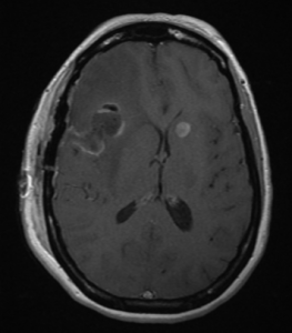 FIGURE 2. After frontal crani