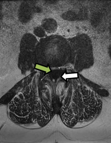 Figure 2. MRI T2-Weighted Axial Image. Large juxtafacet mass at L3-4 from left (white arrow) resulting in severe spinal stenosis on thecal nerve sac (green arrow)