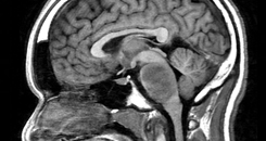 pediatric brainstem glioma