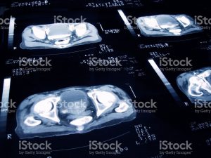 Prostate Cancer X Ray Imagery 
