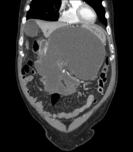 FIGURE: 6-week, follow-up CT scan of patient before intervention.