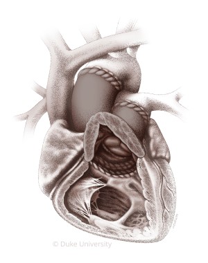 Partial heart transplant illustration