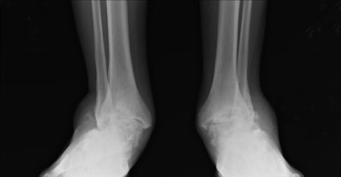 Patient’s preoperative radiograph