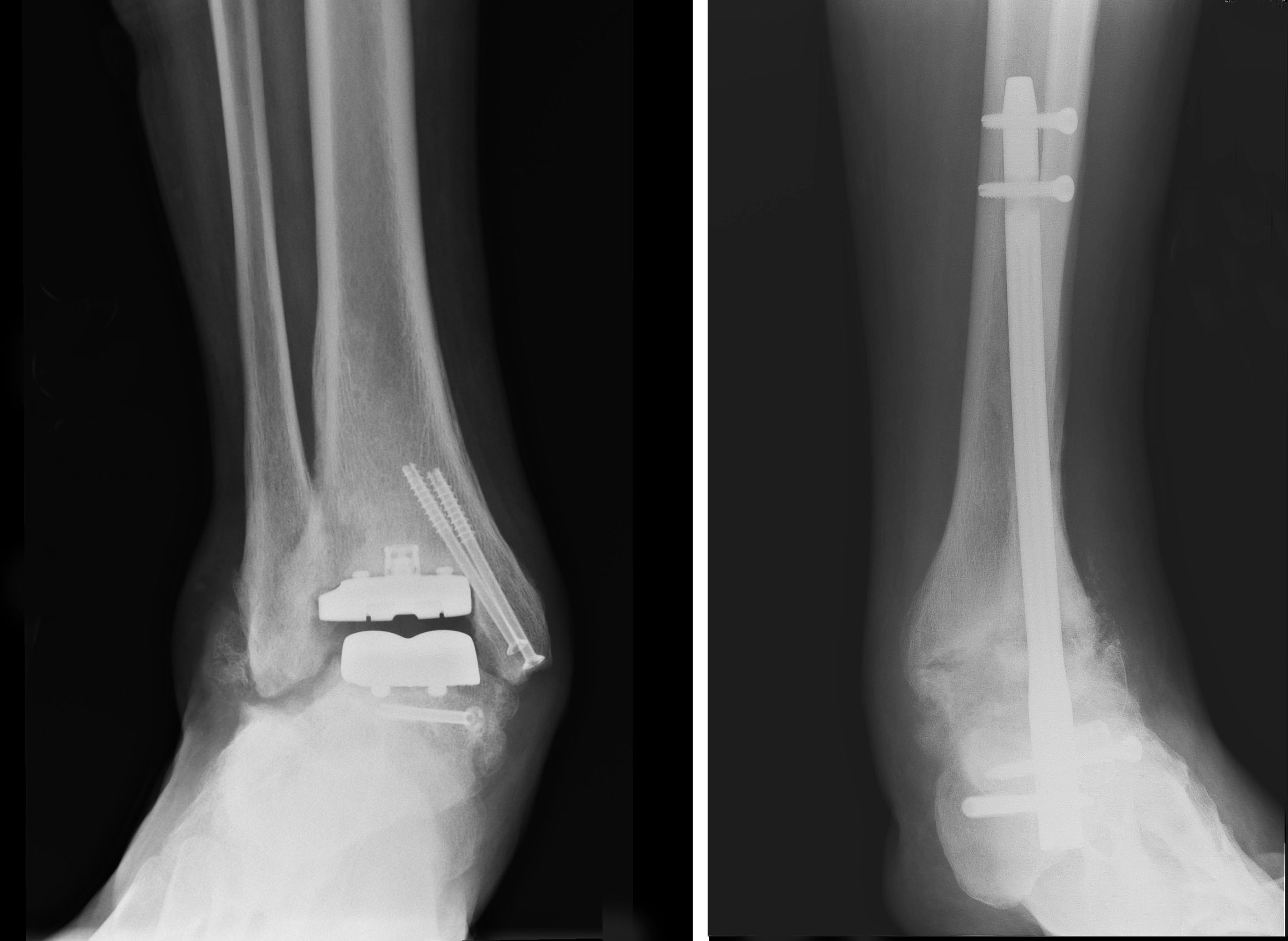 Postoperative right and left ankles