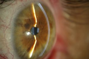 open angle glaucoma eye