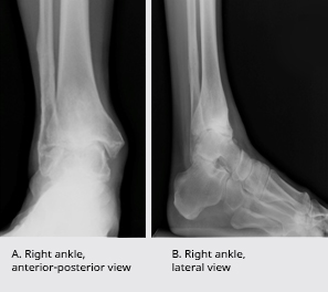 Figure 1. Preoperative weightbearing radiographs of 53-year-old man with end-stage ankle arthritis