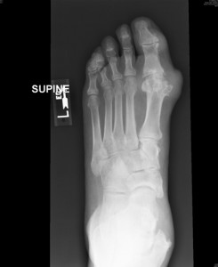 tophus xray