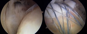 Figure 1. Intraoperative arthroscopic images showing the bald head prior to repair (left) and the rotator cuff with graft and sutures after repair (right)