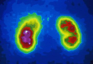 Rare-Diagnosis-Following-Cascading-Decline-in-Kidney-Function