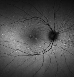 Fundus autofluorescence of the right eye showing hyperautofluorescence corresponding to the yellow lesions.