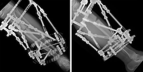 The patient’s tibia six weeks after the initial surgical procedure.