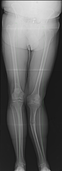 The patient’s preoperative alignment showing a significant tibial malalignment.