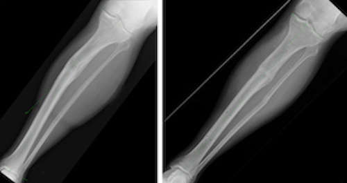 The patient’s tibia preoperatively (left) and nine months postoperatively (right), following deformity correction.